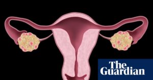 NHS urged to update website after renaming polycystic ovary syndrome | NHS