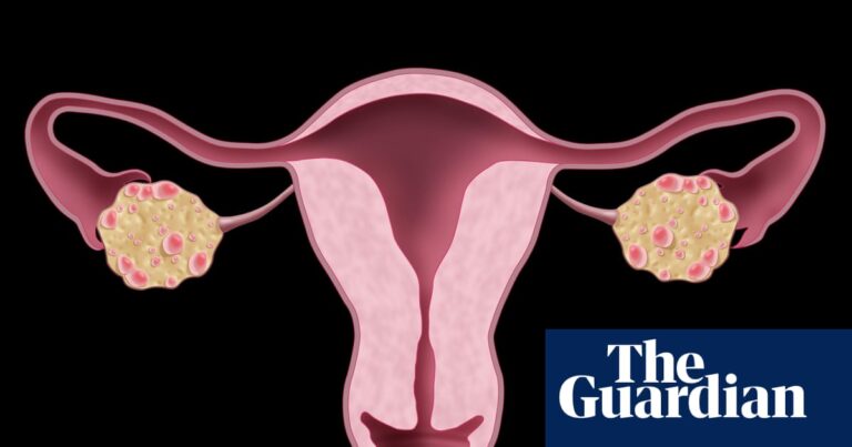 NHS urged to update website after renaming polycystic ovary syndrome | NHS